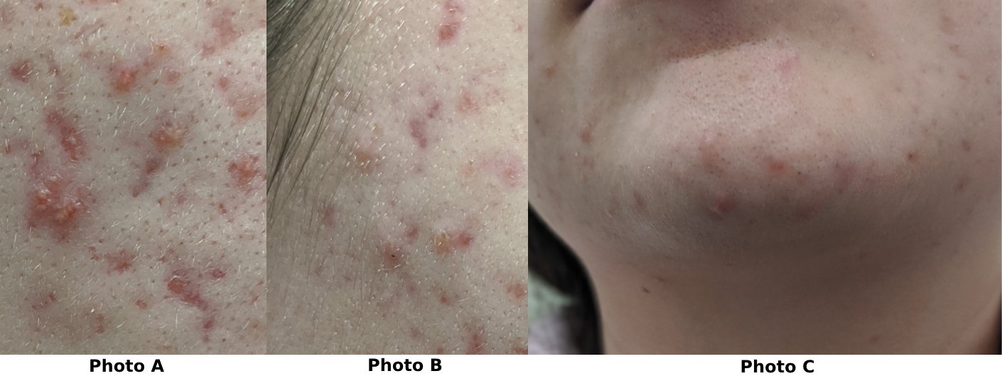 3 photo set showing acne on a teenager's face