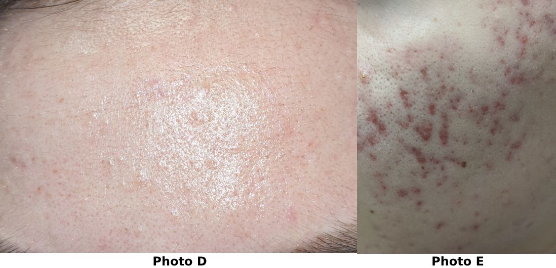 photos showing acne improving on a teenager's face