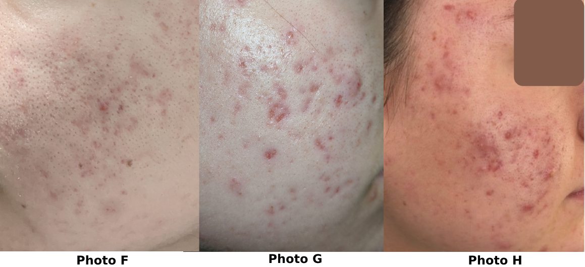 photos showing progression of acne scars healing on a teenager's face