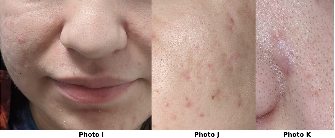 photos showing great improvement of acne pigmentation