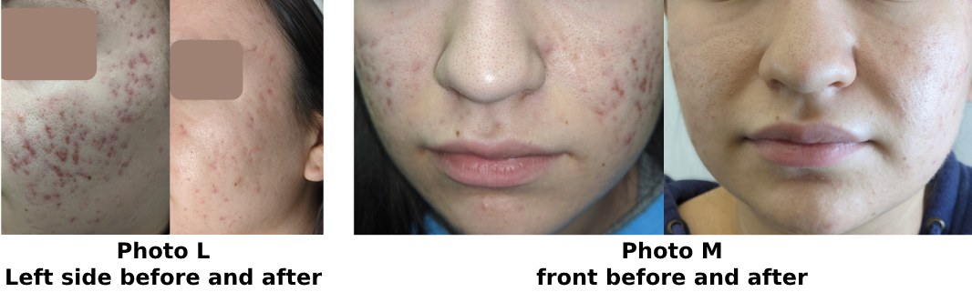 photos showing before and after acne improvement from chinese medicine