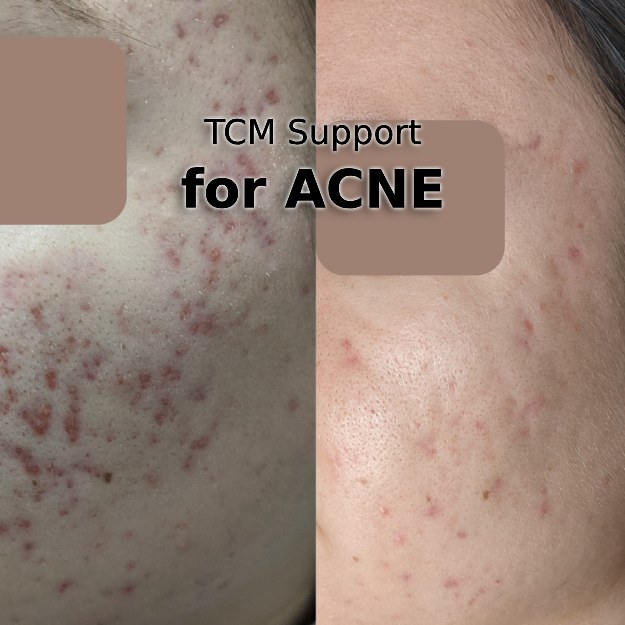 photo of a before and after acne case showing improvement with text that says tcm for acne click for article