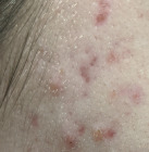 close up photo acne on a face