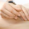 Image of hands inserting acupuncture needles